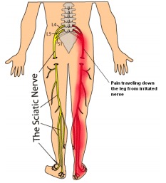 Disc Herniation / Sciatica – Trusha Shah, MD